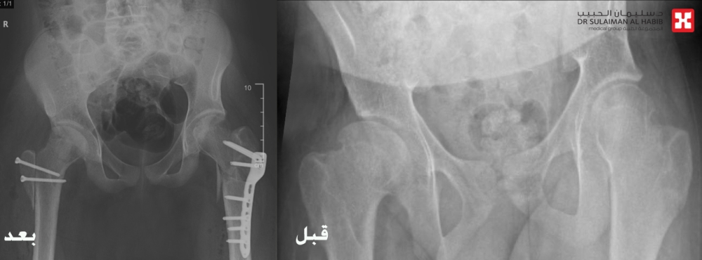 مستشفى-الدكتور-سليمان-الحبيب-بالخبر-يُعيد-قدرة-المشي-لشاب-بعد-معاناة-10-سنوات-نتيجة-تموت-عظم-عنق-الفخذ