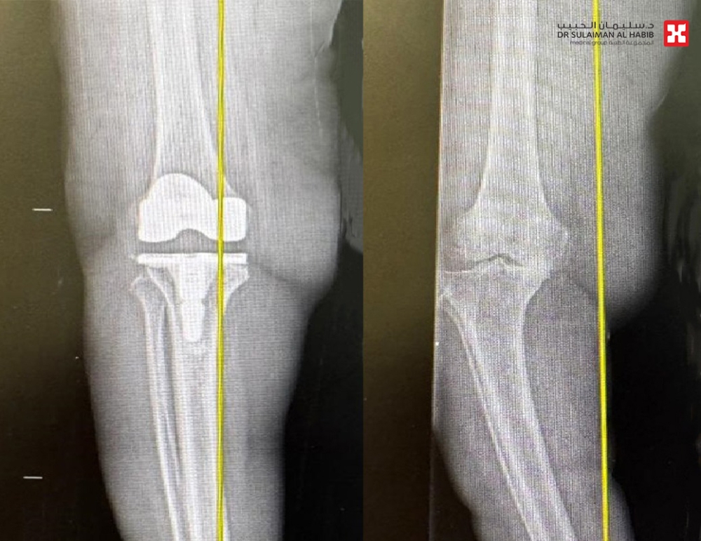 مستشفى‎-الدكتور-سليمان-الحبيب-بالخبر-يجري-عملية-استبدال-ركبة-ناجحة-باستخدام-الروبوت-الجراحي-تحت-التخدير-النصفي