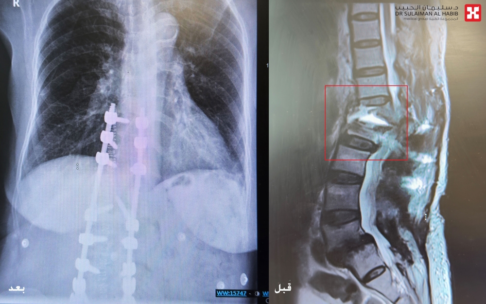 مستشفى-الدكتور-سليمان-الحبيب-بالخبر-يُعيد-قدرة-المشي-لسبعينية-أصيبت-بتشوه-بالعمود-الفقري-نتيجة-“5”-عمليات-سابقة-غير-ناجحة