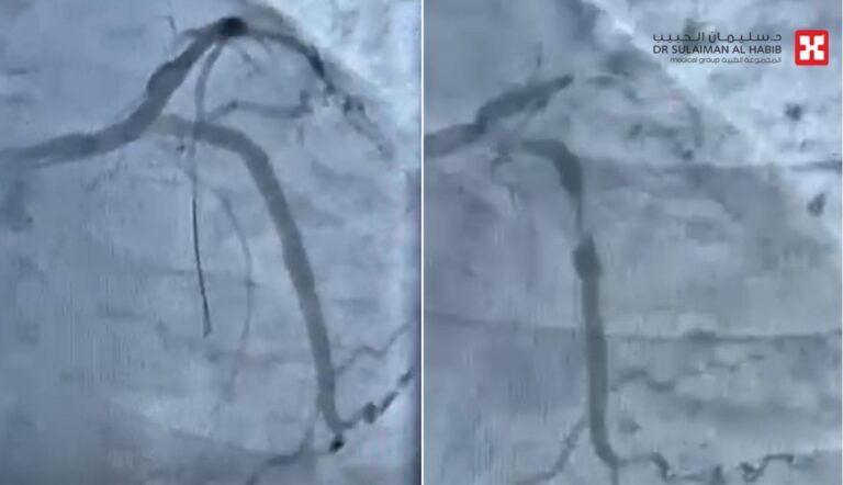 مستشفى-الدكتور-سليمان-الحبيب-بالخبر-ينقذ-حياة-مراجع-توقف-قلبه-بسبب-انسداد-كلي-للشريان-النازل