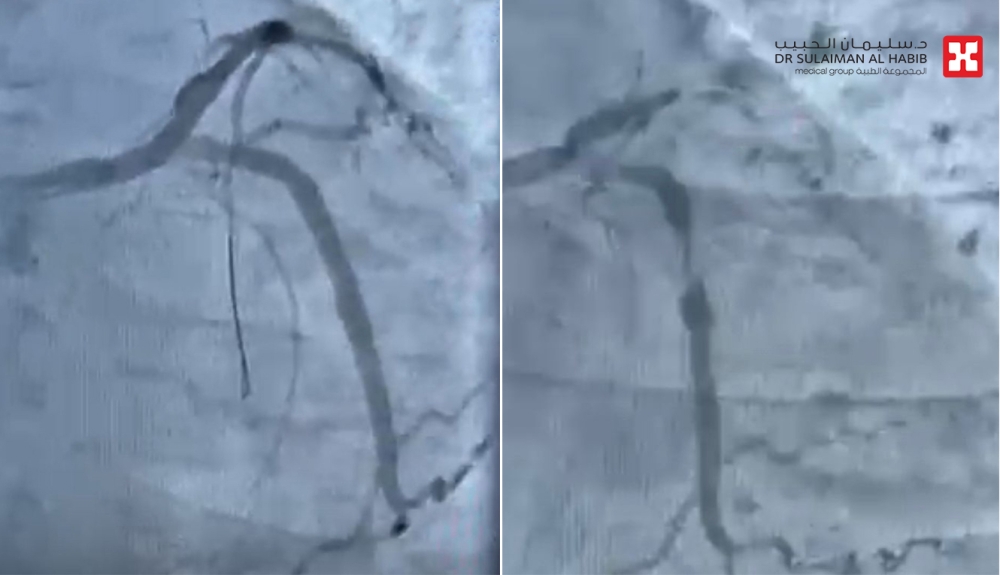 مستشفى-الدكتور-سليمان-الحبيب-بالخبر-ينقذ-حياة-مراجع-توقف-قلبه-بسبب-انسداد-كلي-للشريان-النازل