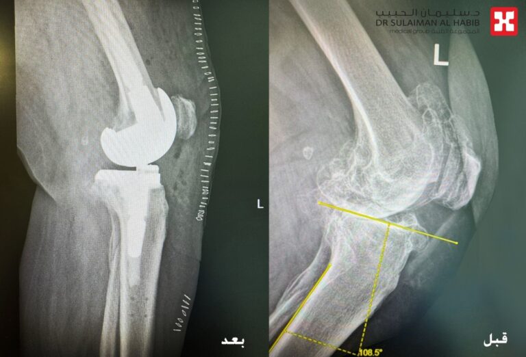 مستشفى-الدكتور-سليمان-الحبيب-بالخبر-يُجري-عملية-زراعة-مفصل-معقدة-بتقنية-“الروبوت-الجراحي”-لإعادة-قدرة-المشي-لثمانينية