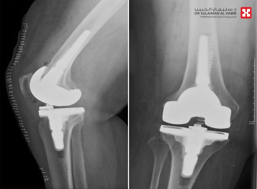 عملية-استبدال-مفصل-ركبة-بالروبوت-الجراحي-بمستشفى-الدكتور-سليمان-الحبيب-بالخبر-تنهي-معاناة-سيدة-استمرت-لـ”10″-سنوات