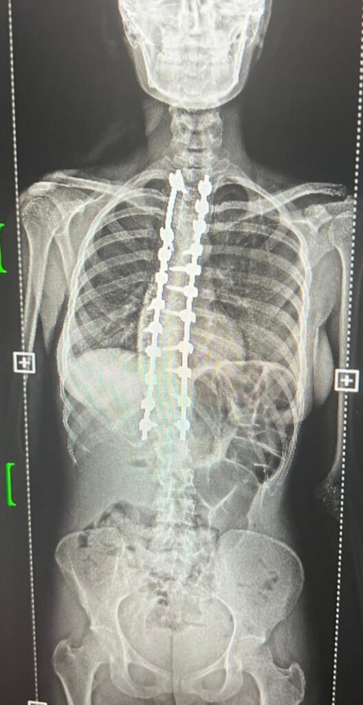 “مركزي”-القطيف-ينجح-في-إجراء-أول-عمليات-تصحيح-انحناء-العمود-الفقري