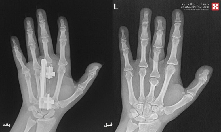 جراحة-ميكروسكوبية-بمستشفى-الدكتور-سليمان-الحبيب-بالخبر-تُنهي-معاناة-عشرينية-مع-تشوه-خلقي-باليدين