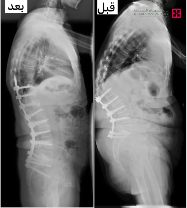 مسن-يستعيد-حياته-ومظهره-الطبيعيين-بعد-عملية-تصحيحية-لتعديل-الحدب-بمستشفى-الدكتور-سليمان-الحبيب-بالخبر