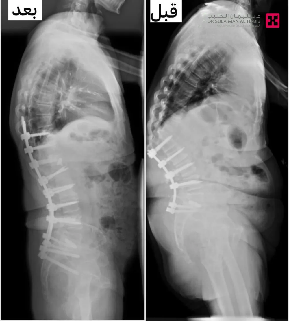 مسن-يستعيد-حياته-ومظهره-الطبيعيين-بعد-عملية-تصحيحية-لتعديل-الحدب-بمستشفى-الدكتور-سليمان-الحبيب-بالخبر