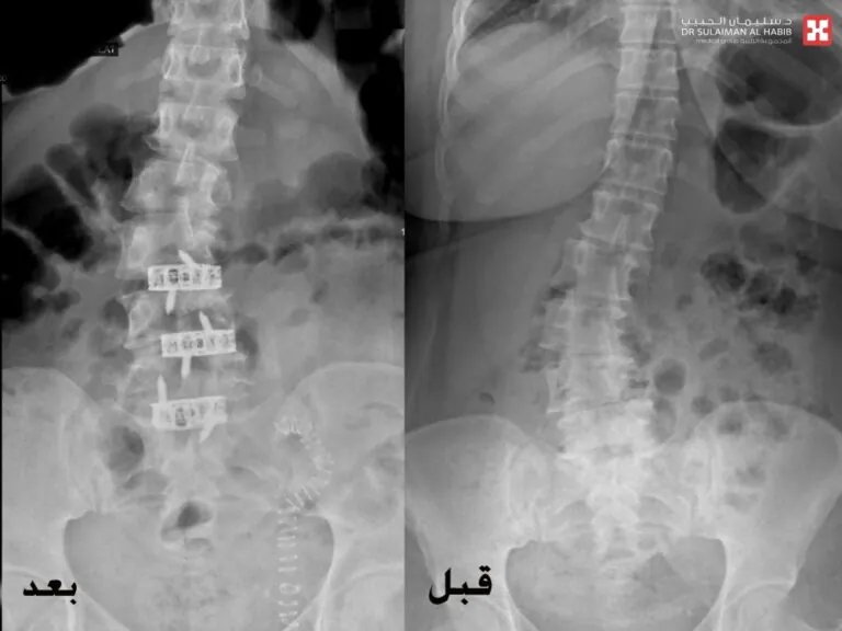جراحة-متقدمة-لتعديل-العمود-الفقري-من-الأمام-تُعيد-خمسينية-لحياتها-الطبيعية-بمستشفى-الدكتور-سليمان-الحبيب-بالخبر