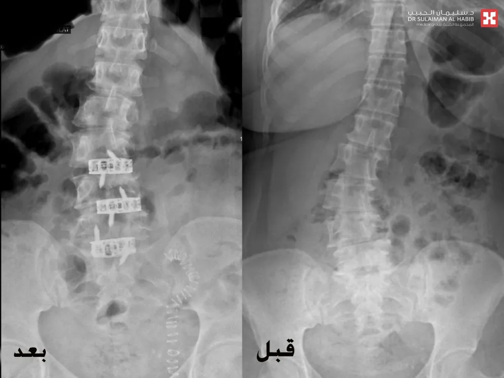 جراحة-متقدمة-لتعديل-العمود-الفقري-من-الأمام-تُعيد-خمسينية-لحياتها-الطبيعية-بمستشفى-الدكتور-سليمان-الحبيب-بالخبر