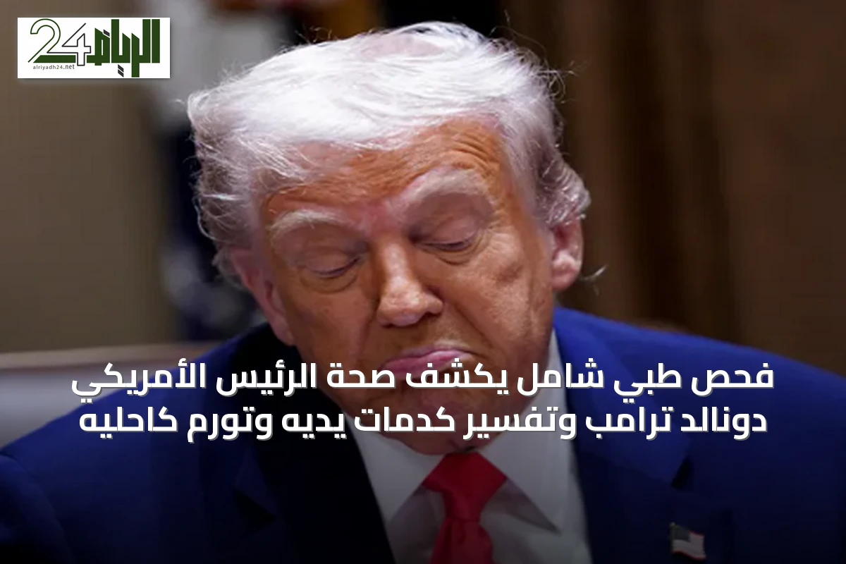 فحص طبي شامل يكشف صحة الرئيس الأمريكي دونالد ترامب وتفسير كدمات يديه وتورم كاحليه