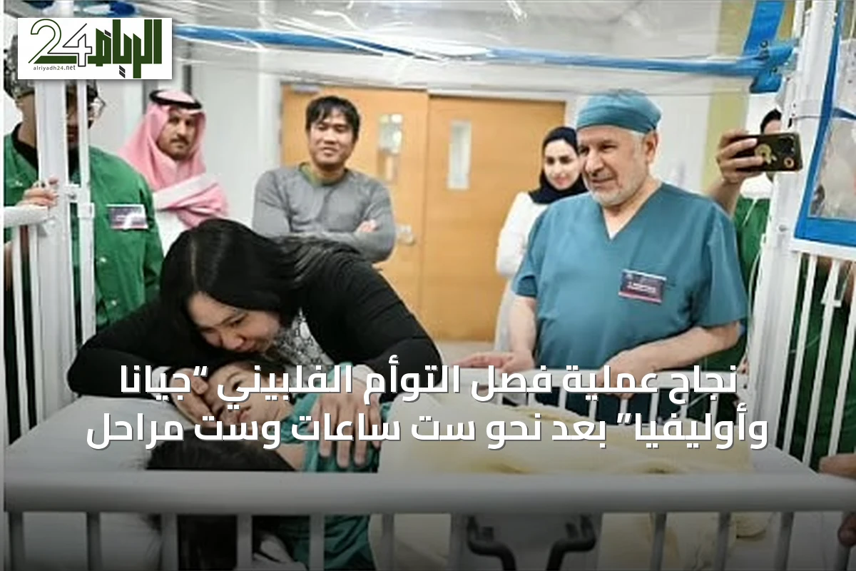 نجاح عملية فصل التوأم الفلبيني “جيانا وأوليفيا” بعد نحو ست ساعات وست مراحل