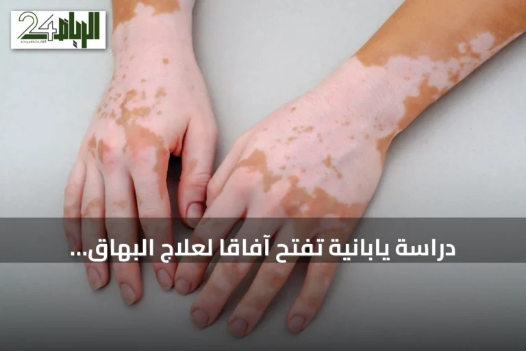 دراسة يابانية تفتح آفاقاً لعلاج البهاق عبر تنشيط الخلايا الصبغية