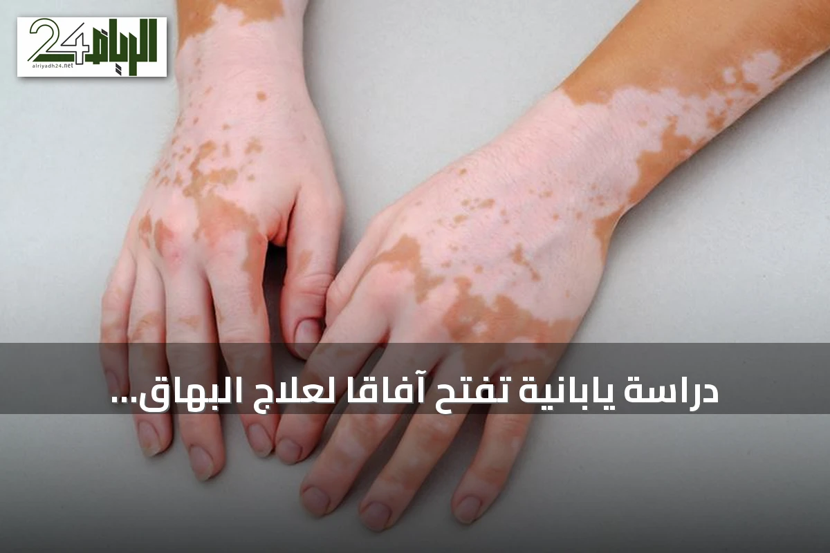 دراسة يابانية تفتح آفاقاً لعلاج البهاق عبر تنشيط الخلايا الصبغية