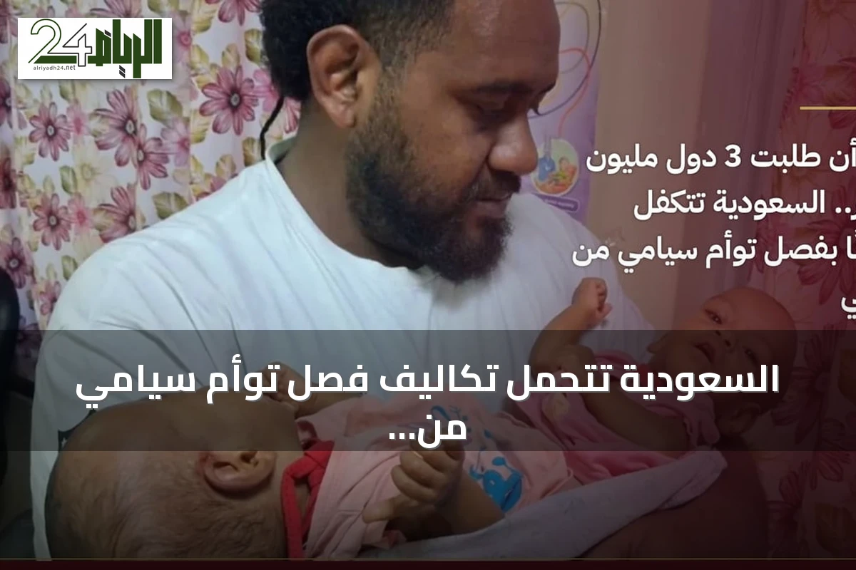 السعودية تتحمل تكاليف فصل توأم سيامي من فيجي بعد طلب ثلاث دول مليون دولار