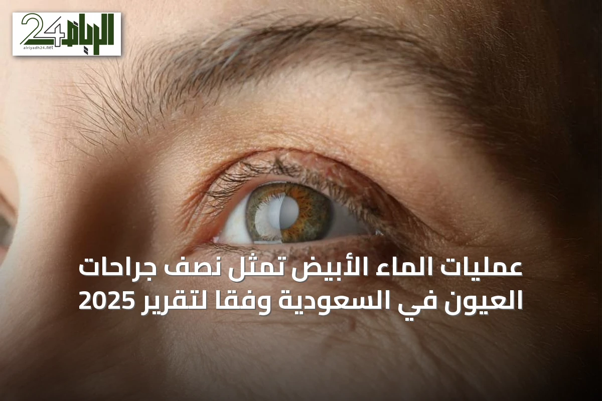 عمليات الماء الأبيض تمثل نصف جراحات العيون في السعودية وفقًا لتقرير 2025