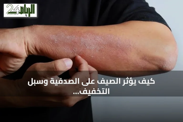 كيف يؤثر الصيف على الصدفية وسبل التخفيف من تهيجها