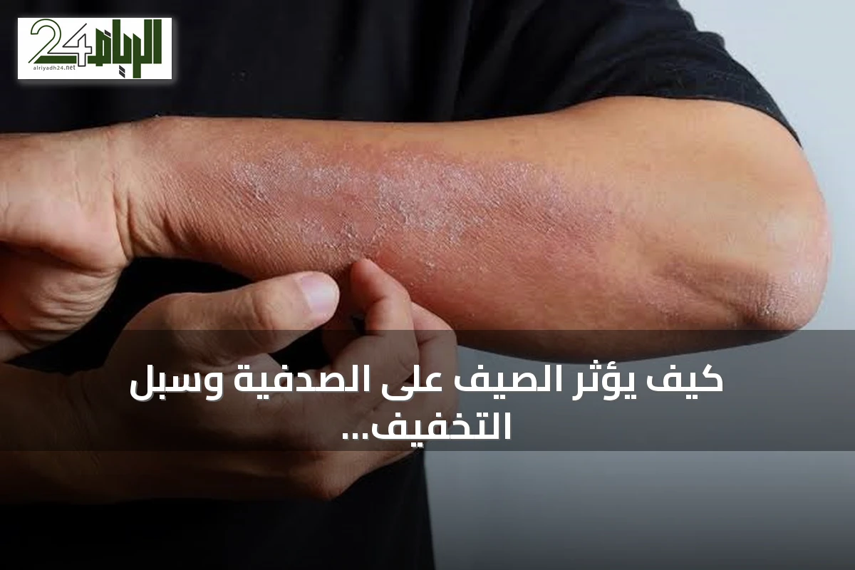 كيف يؤثر الصيف على الصدفية وسبل التخفيف من تهيجها
