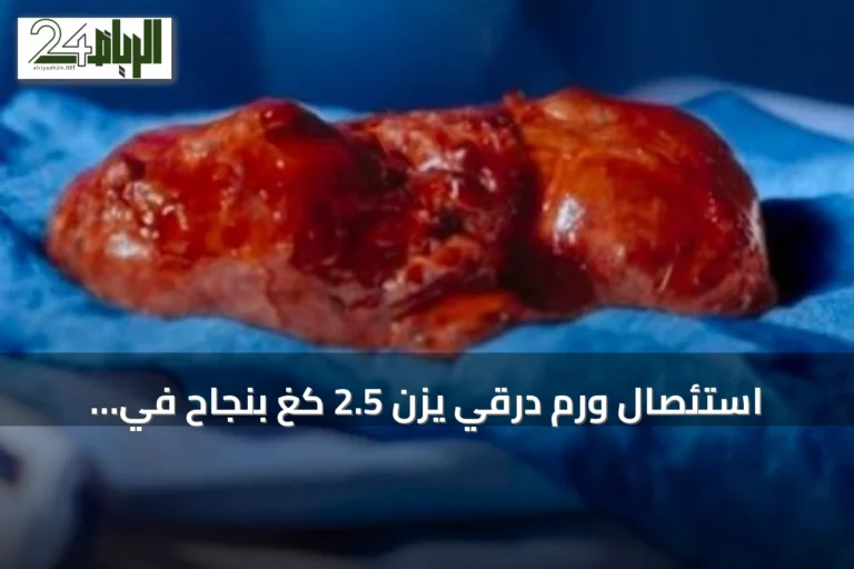 استئصال ورم درقي يزن 2.5 كغ بنجاح في مستشفى د. خالد الرحيمي