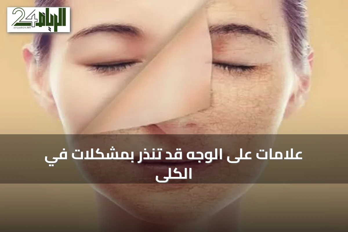 علامات على الوجه قد تنذر بمشكلات في الكلى