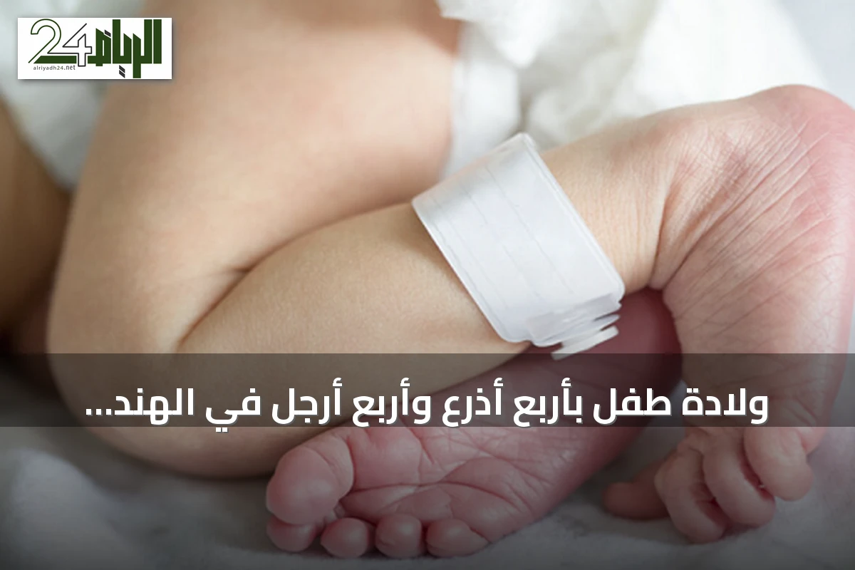 ولادة طفل بأربع أذرع وأربع أرجل في الهند يثير جدلاً طبياً
