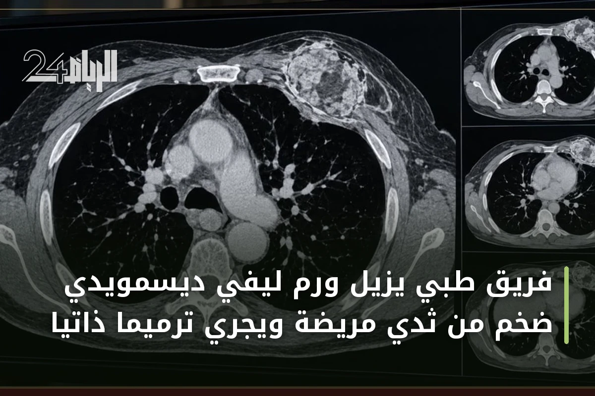 فريق طبي يزيل ورم ليفي ديسمويدي ضخم من ثدي مريضة ويجري ترميماً ذاتياً