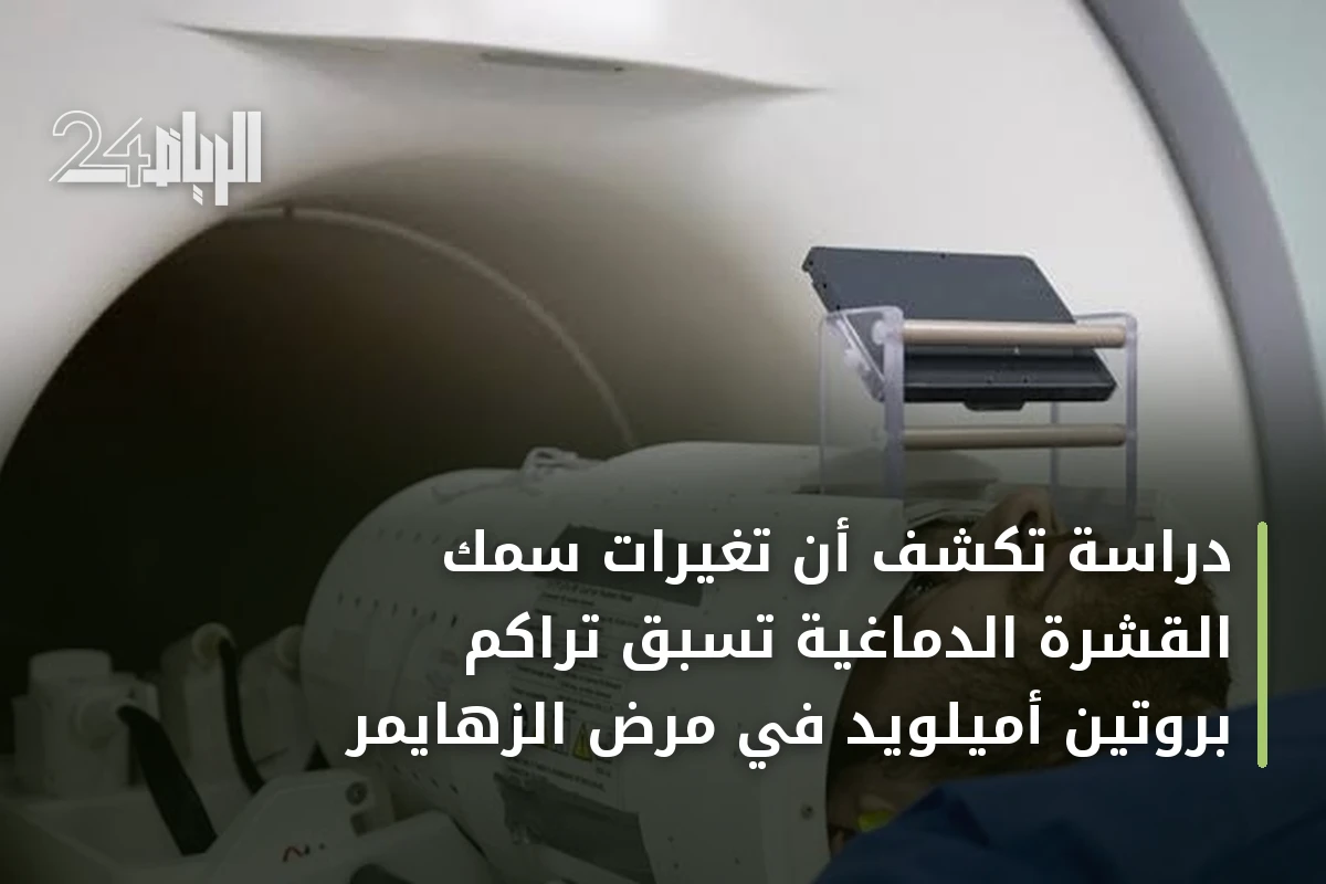 دراسة تكشف أن تغيرات سُمك القشرة الدماغية تسبق تراكم بروتين أميلويد في مرض الزهايمر