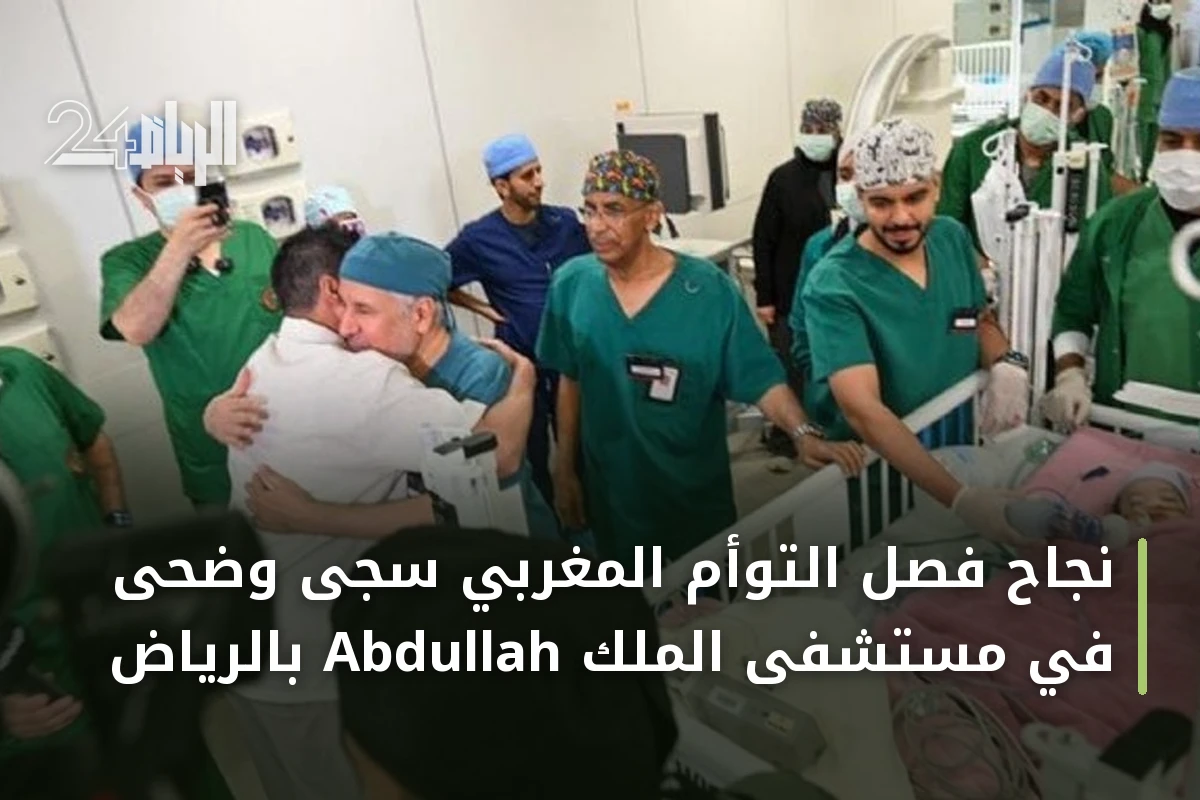 نجاح فصل التوأم المغربي سجى وضحى في مستشفى الملك Abdullah بالرياض